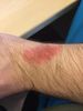 8 days after removing the Force, it has gotten worse over that time
