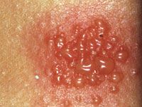 Strong Positve allergy patch test.jpg