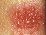 Strong Positve allergy patch test.jpg