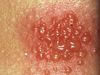 Strong Positve allergy patch test.jpg