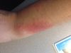 Wrist burn