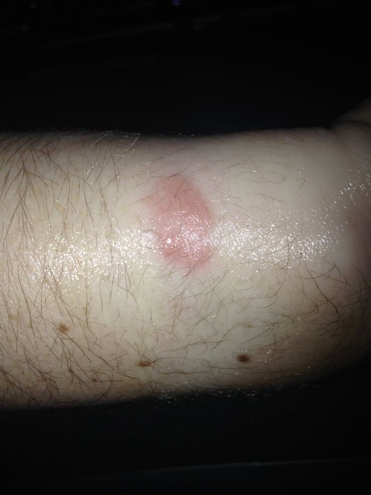 rash/burn from my force.