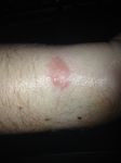 rash/burn from my force.