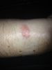 rash/burn from my force.