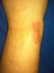 Force Rash