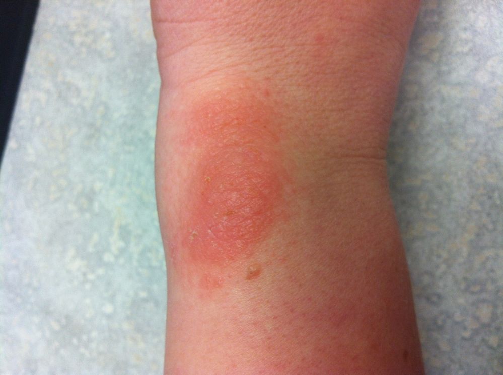 Left Wrist 1-23-14.JPG