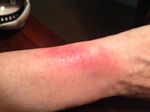 ForceFitbitRash-LeftWrist.JPG
