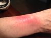 ForceFitbitRash-LeftWrist.JPG