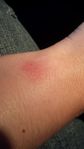 Fitbit Force skin reaction