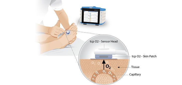 transcutaneous-oximetry-tcpo2-tcom.jpg