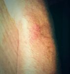 FitBit Force Contact dermatitis Rash