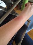 Fitbit Force Rash
