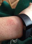 Rash