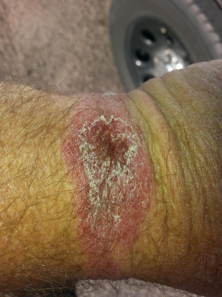 About 3 weeks after I stopped wearing the band