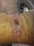 About 3 weeks after I stopped wearing the band