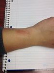 fitbit force rash.jpg