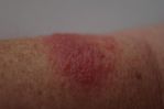 Fitbit Force Rash