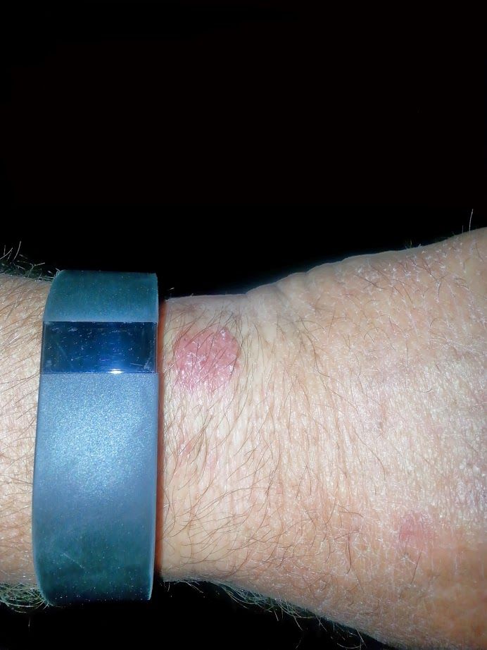 Rash2.jpg