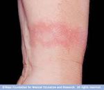 contact dermatitis 3.jpg