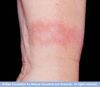 contact dermatitis 3.jpg