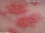 Contacct dermatitis 2.jpg
