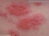 Contacct dermatitis 2.jpg