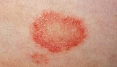 contact dermatitis.jpg