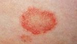contact dermatitis.jpg