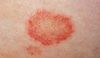 contact dermatitis.jpg