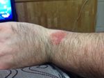 Rash, right arm 5 days after initial appearance