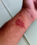 rash at 3 weeks