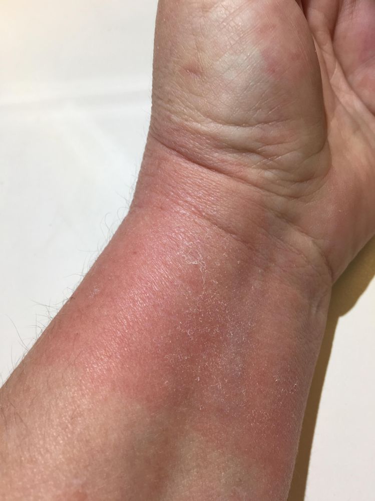 Wrist breaking out from band? - Fitbit Community