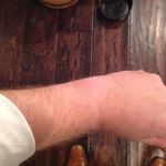 95 percent healed.jpg