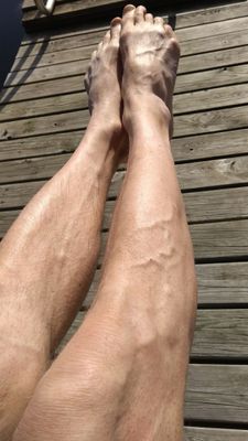 veins_on_legs_8-2017.jpg