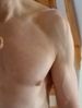 veins_arm_shoulder_5-2017.jpg