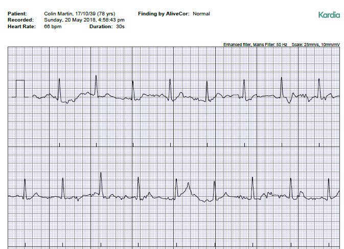 Low resting heart online rate fitbit