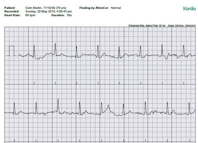 ecg 20may18.jpg