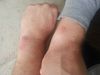 Left Arm Healing Right Arm Starting