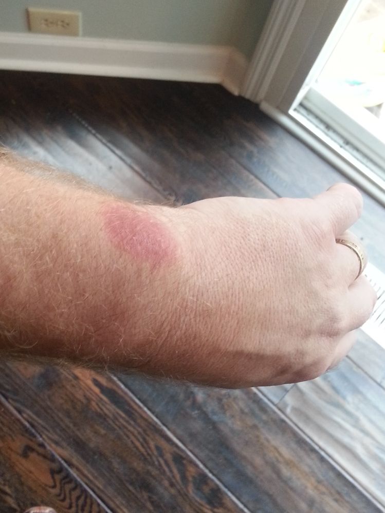 Left Arm after 1 week of treatment