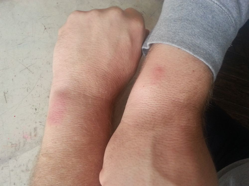 Left Arm Treated Right arm starting